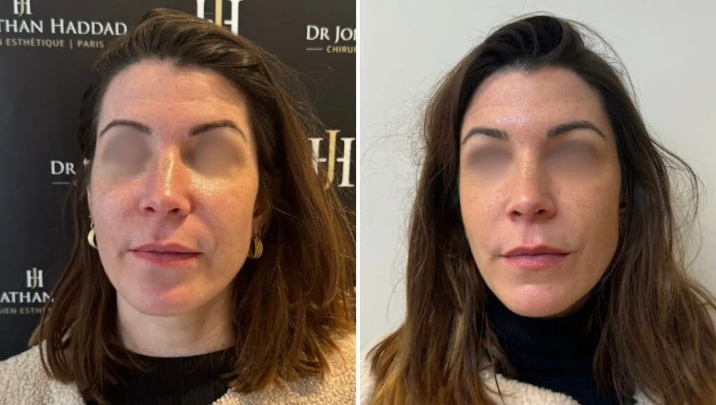 Résultat après 2 séances de Profhilo visage