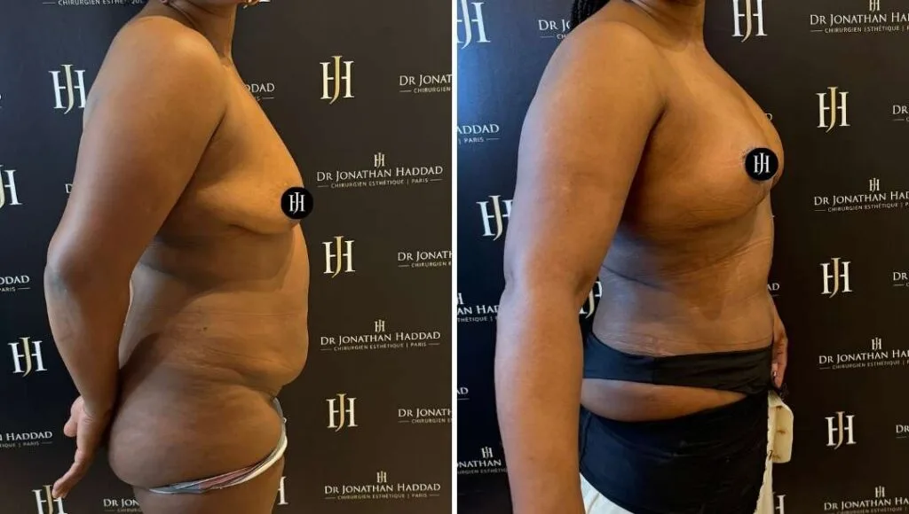 Résultat après une chirurgie mommy makeover