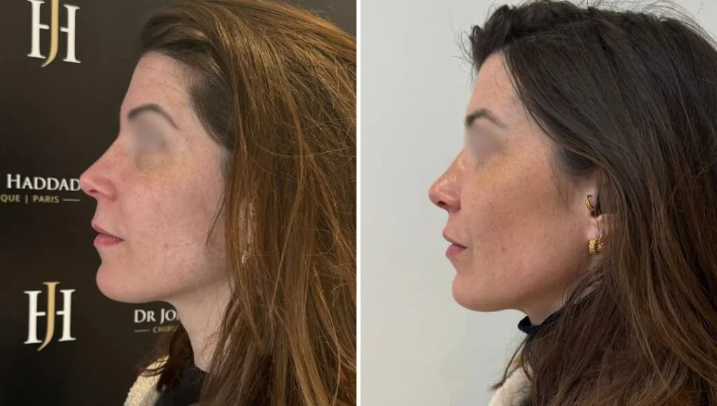 Effets sur le visage après 2 injections de Profhilo 