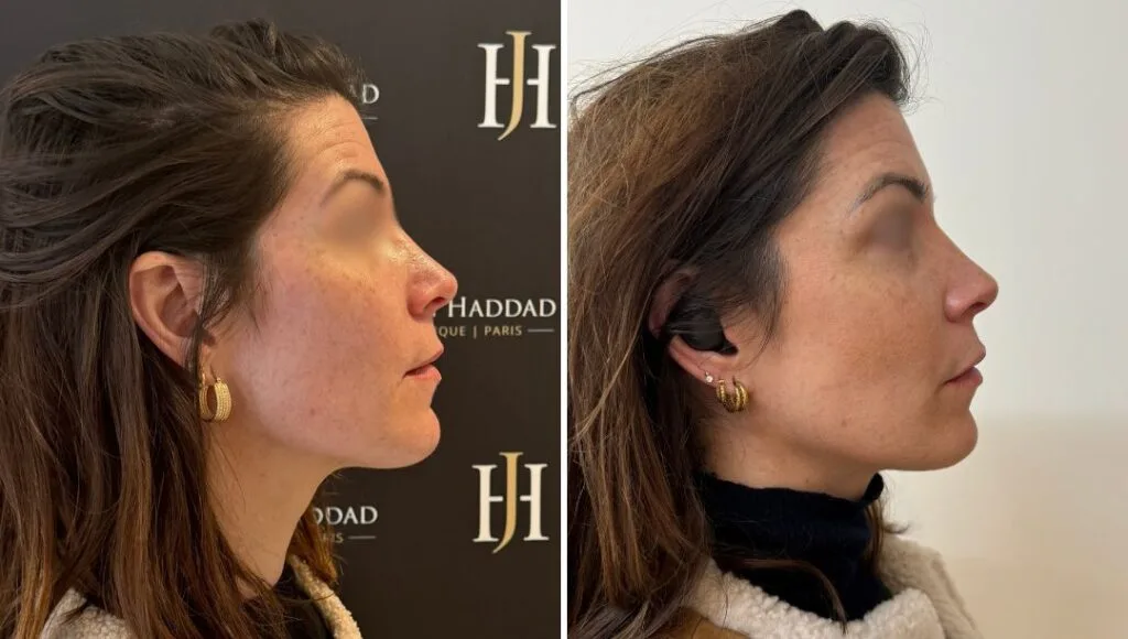 Avant après injections Profhilo visage