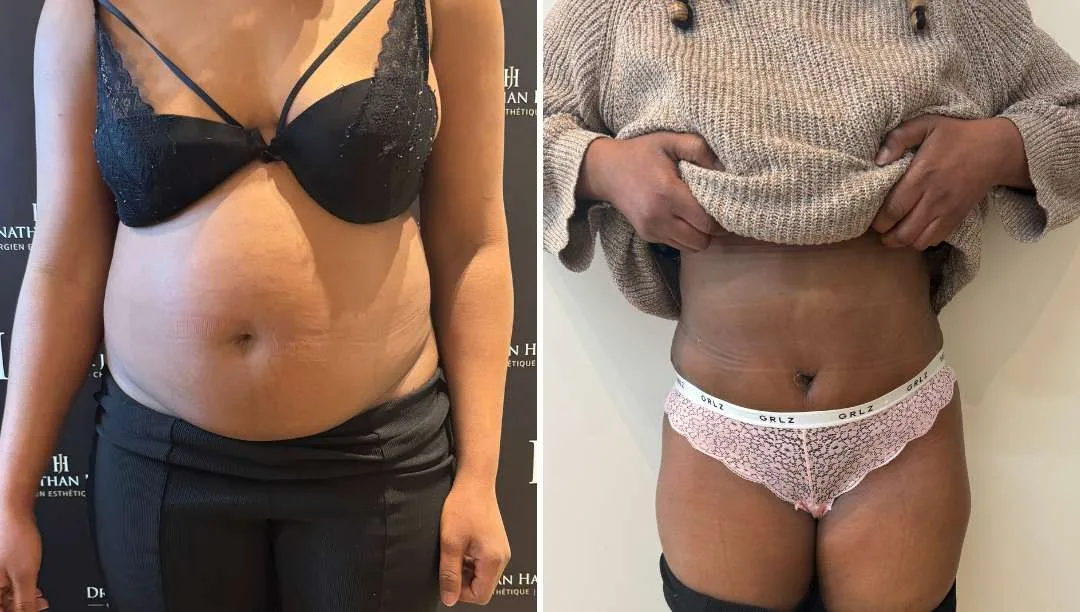 Diastasis correction par abdominoplastie