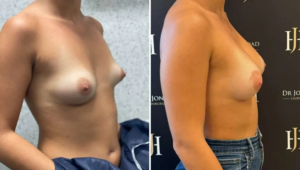 Avant-après chirurgie correctice d'une asymétrie mammaire, augmentation par prothèses prise en charge