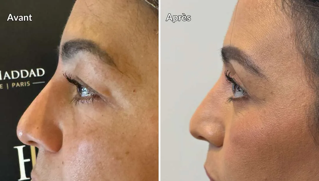 Avant-après Blépharoplastie des paupières supérieures et inférieures