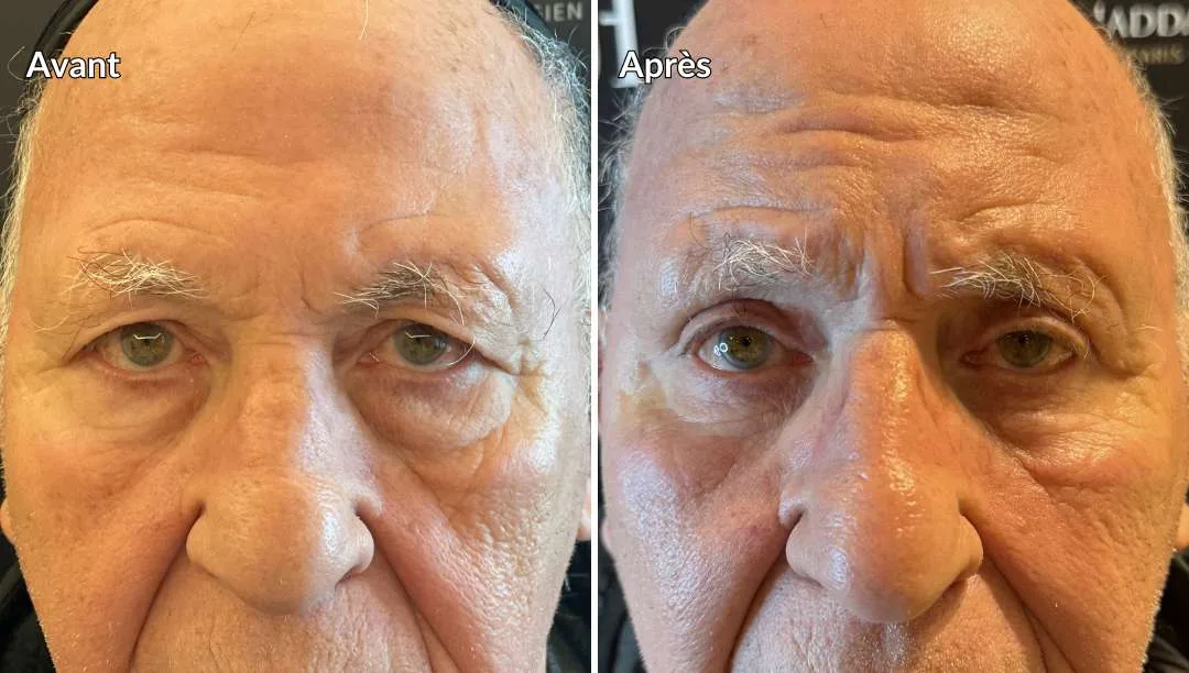 Avant-après chirurgie des paupières par le Dr HADDAD