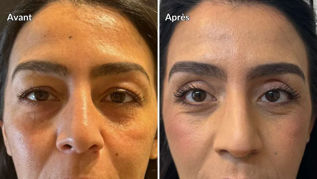 Résultat d'une chirurgie des paupières supérieures et inférieures