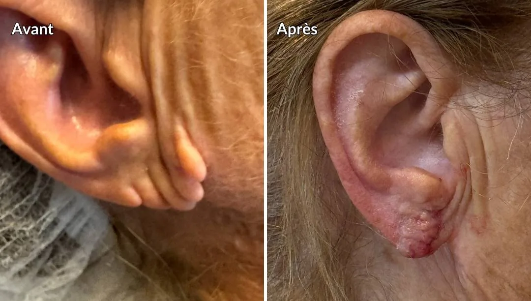 Avant Après réparation d'un lobe fendu