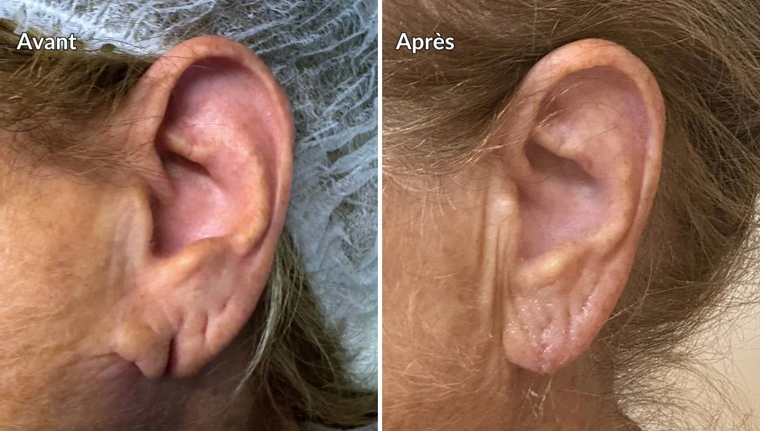Reconstruction du lobe d'oreille fendu ou déchiré