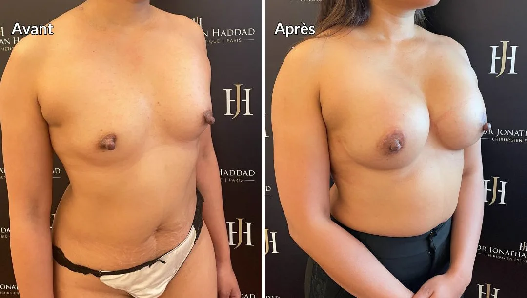 Avant-Après augmentation mammaire par implants par le Dr Haddad