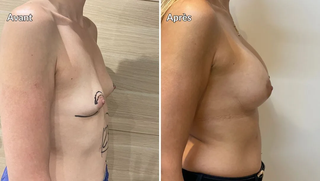 Correction hypertrohpie mammaire par augmentation par implants