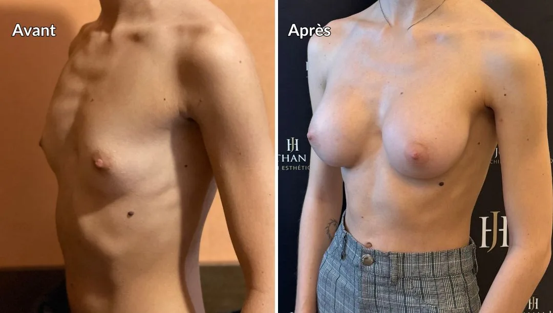augmentation mammaire par implants prise en charge par la cpam