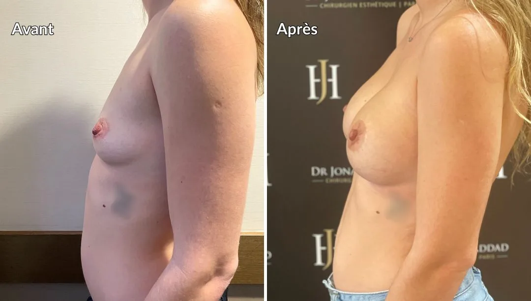 Avant Après augmentation mammaire par implants