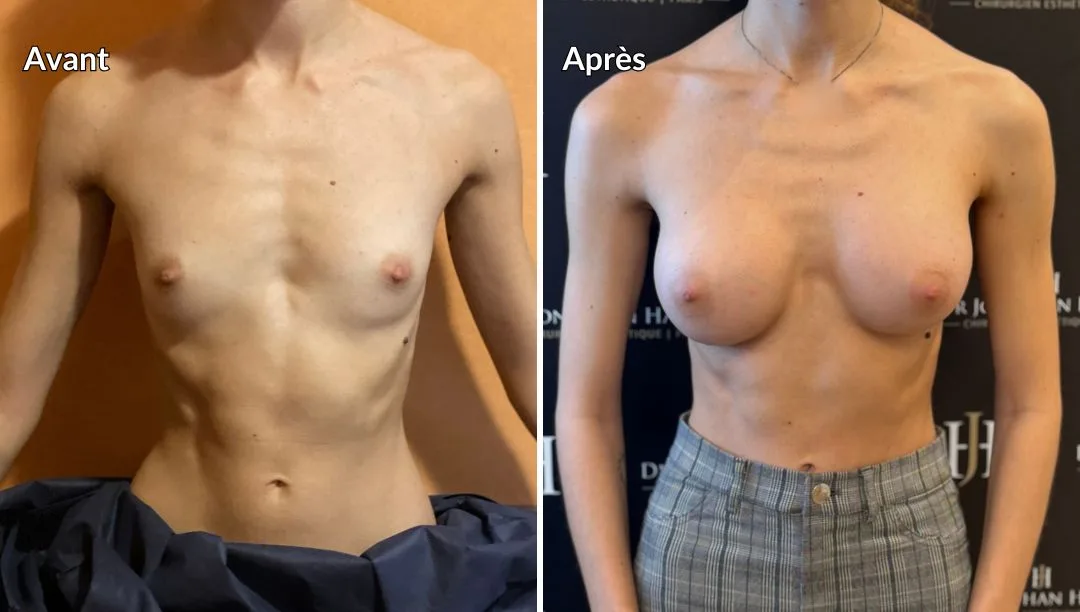 Avant Après augmentation par implants mammaires 300cc
