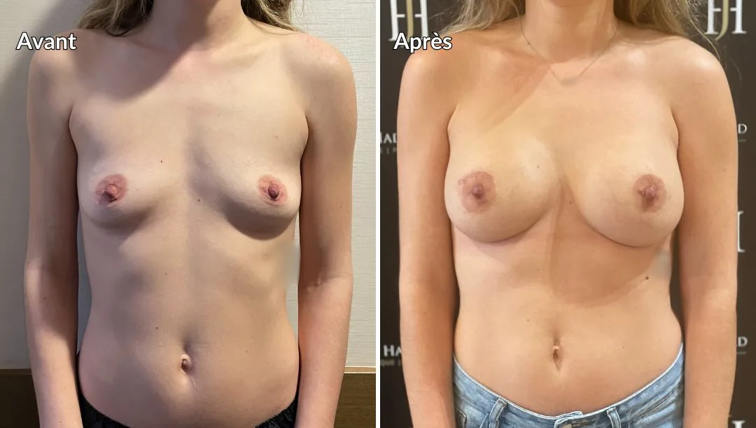 Résultat augmentation mammaire implants à Paris