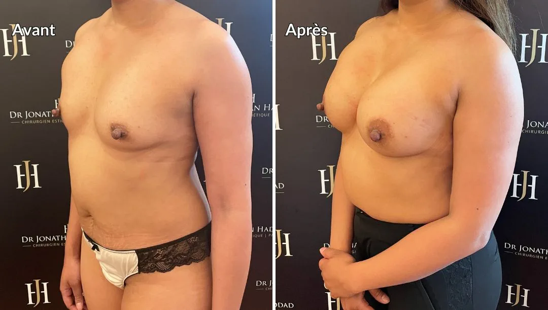Augmentation mammaire par implants à Paris