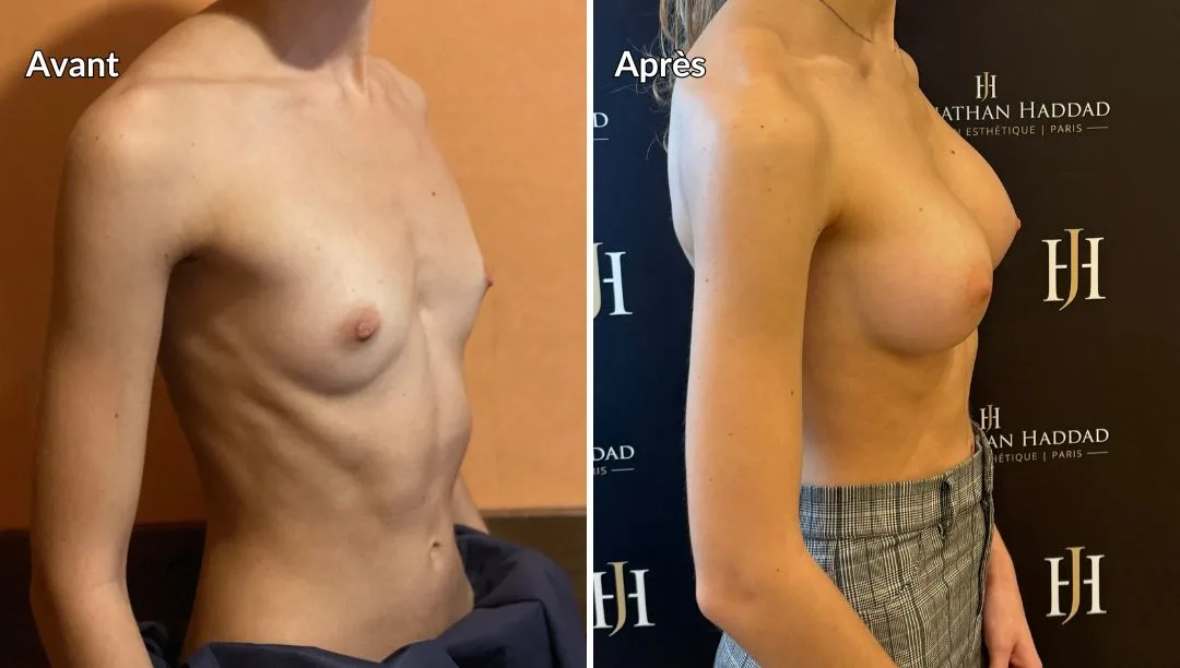 Avant-après augmentation des seins par prothèses, pris en charge par la cpam