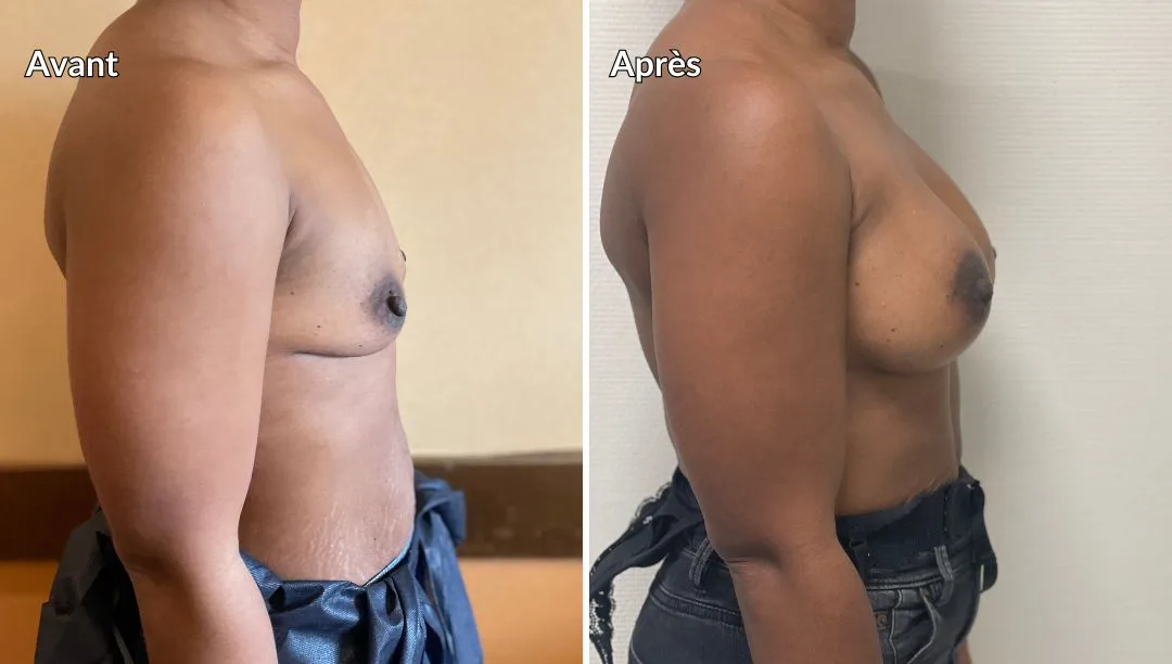 Augmentation mammaire prothèses après 6 mois