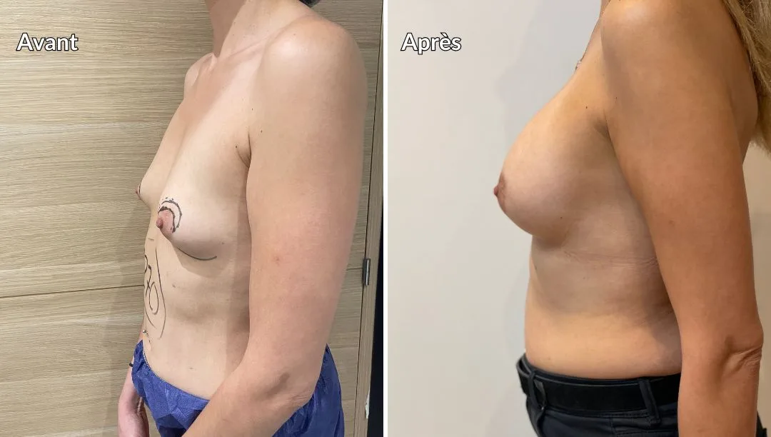 Correction hypertrophie mammaire par implants mammaire