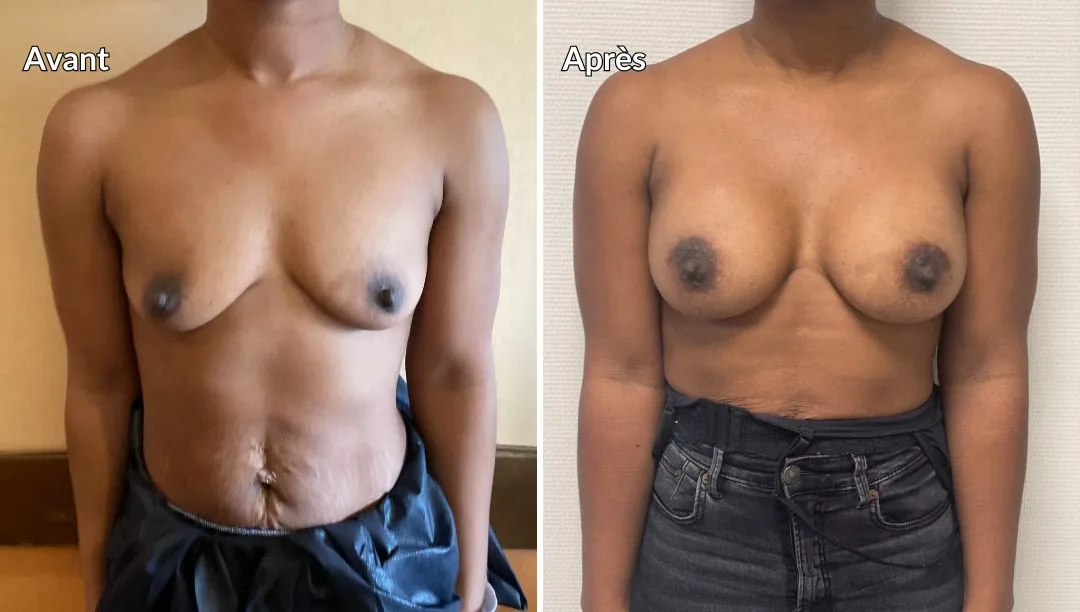 Photos augmentation mammaire après 6 mois