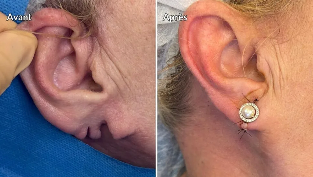 Réparation du lobe avec boucle d'oreille en place