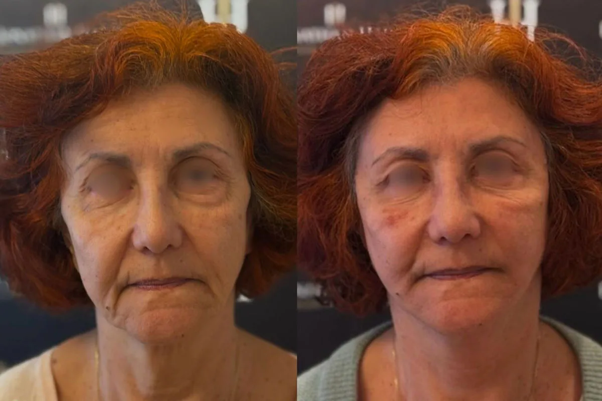 Deep Plane Facelift Avant- Après