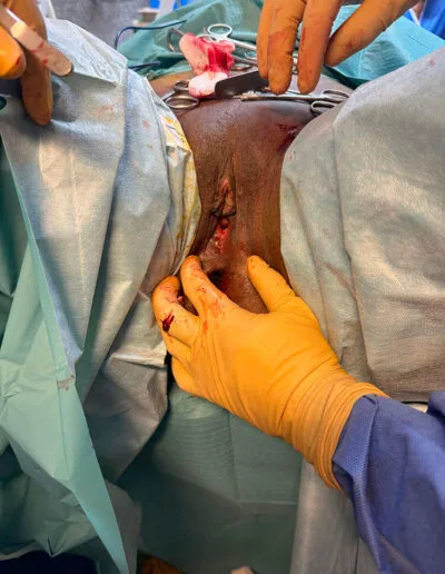 Cicatrice après Hymenoplastie
