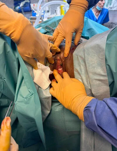 Suture lors d'une reconstruction de l'hymen