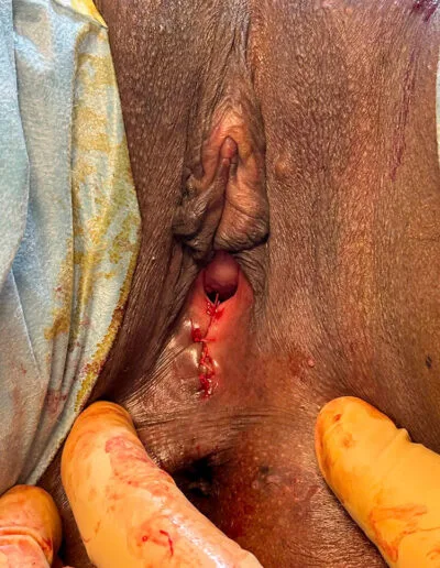 Hyménoplastie, reconstruction de l'hymen à PAris