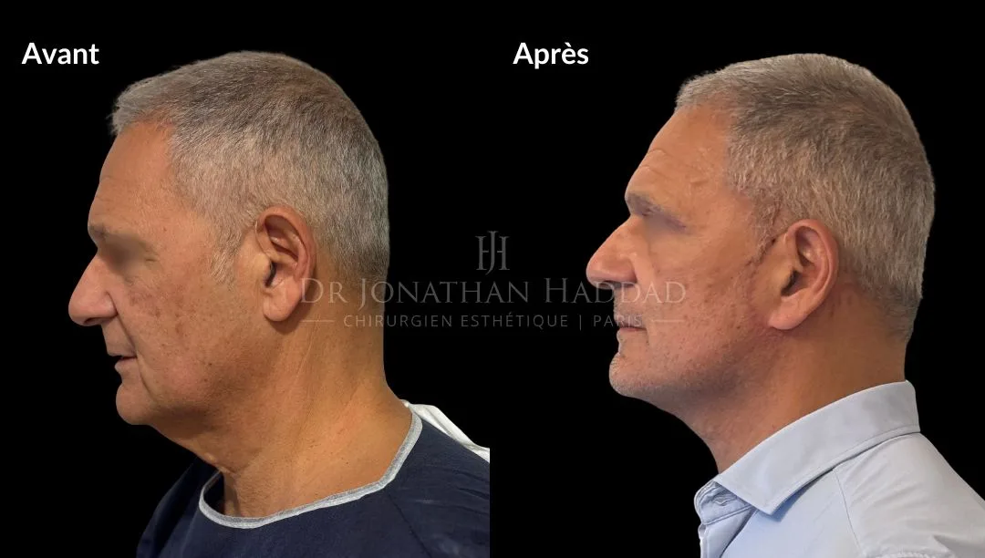 Lifting du visage pour homme