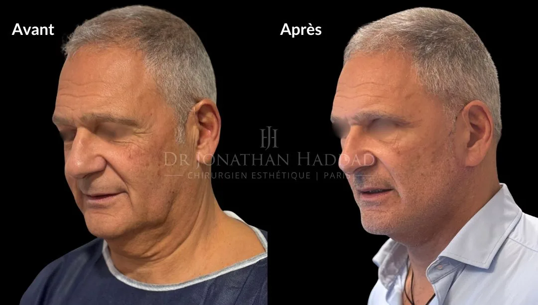 Avant-après lifting visage homme à paris