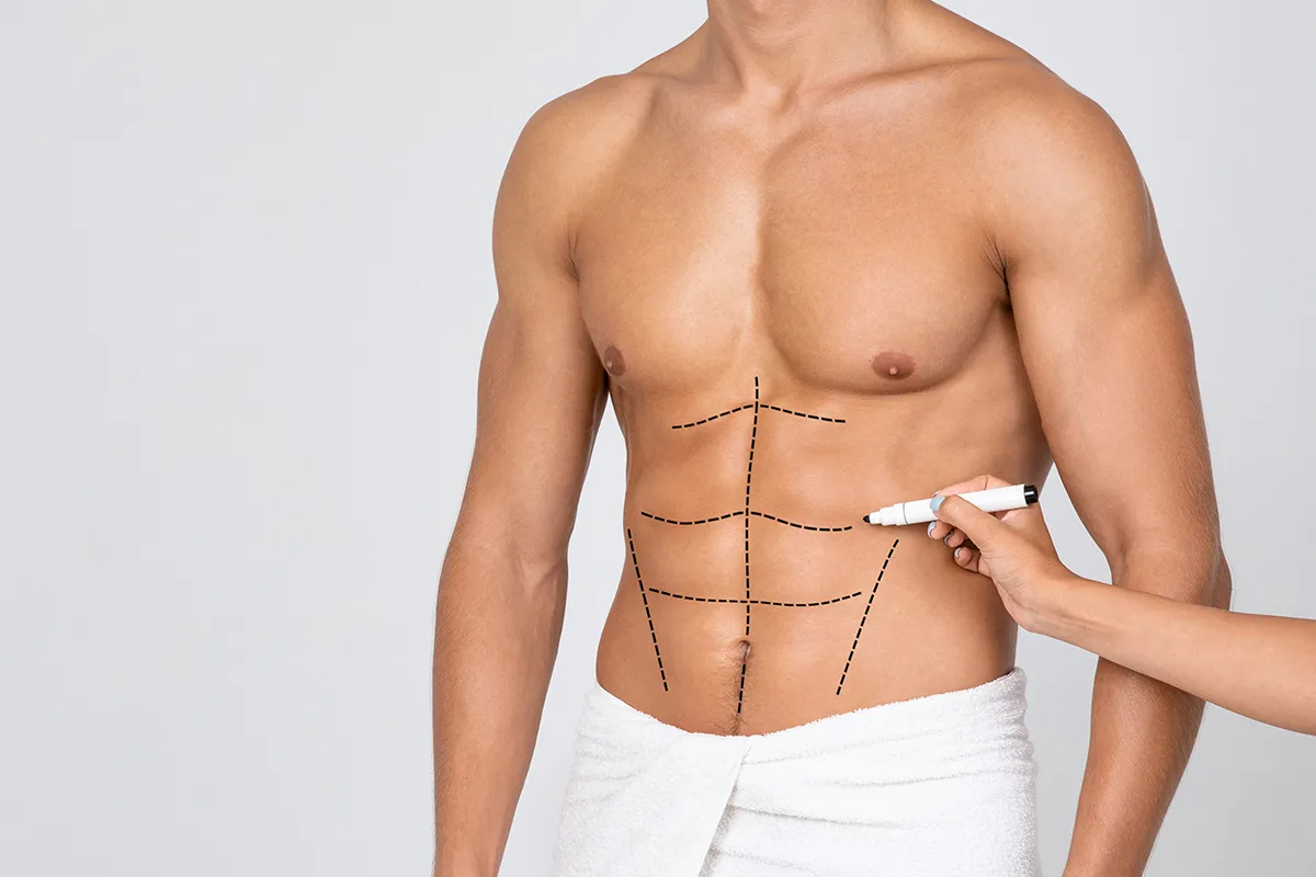 Abdominal etching, chirurgie à Paris par le Dr HADDAD