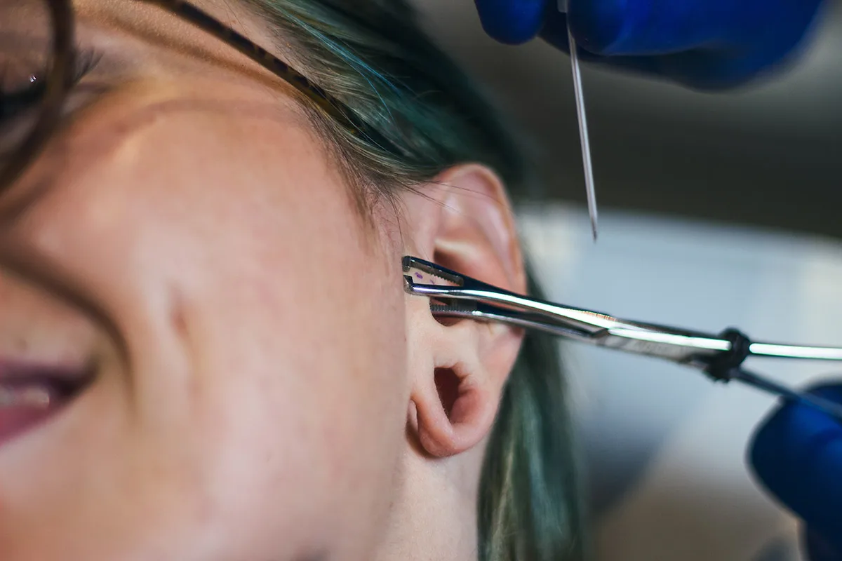 Suture du lobe d'oreilles après écarteurs